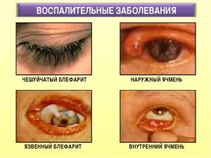 Блефарит: причини, симптоми, види, лікування як лікувати мейбоміевий блефарит