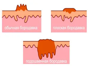 як лікувати папіломи під грудьми