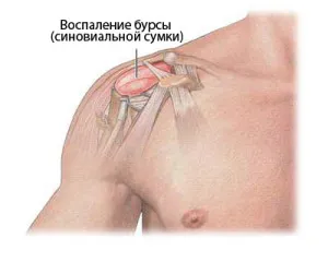 як лікувати вапняний бурсит