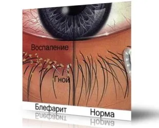 Блефарит очей: причини, симптоми, лікування і профілактика як лікувати блефарит очей