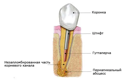 як лікувати флюс під коронкою