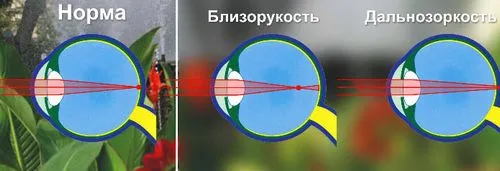 як лікувати короткозорість очей