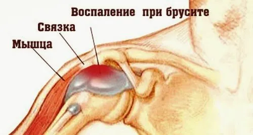 ніж лікувати бурсит плечового суглоба