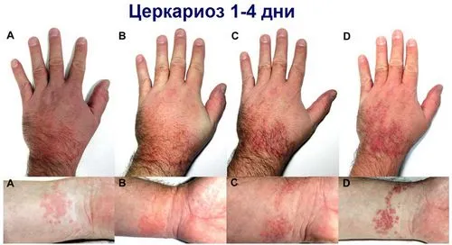 шістосомний дерматит як лікувати