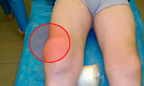 як лікувати підколіннийм'яз бурсит