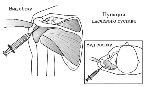 ніж лікувати бурсит плечового суглоба