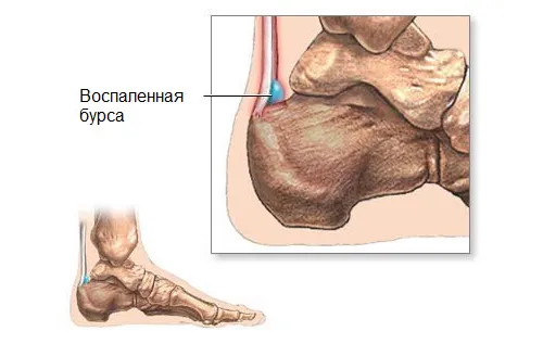 як лікувати бурсит гомілковостопного суглоба