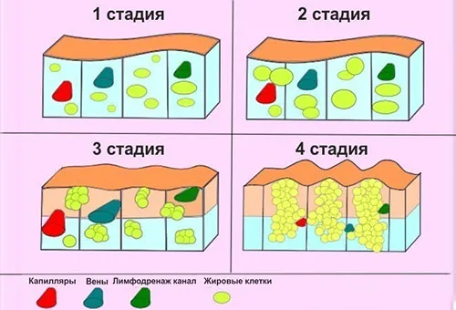 як вилікувати целюліт на ногах