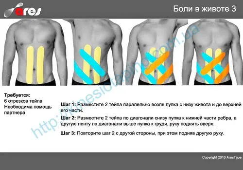 як лікувати розрив м'язів живота