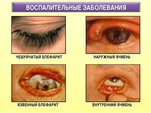 як лікувати хронічний блефарит