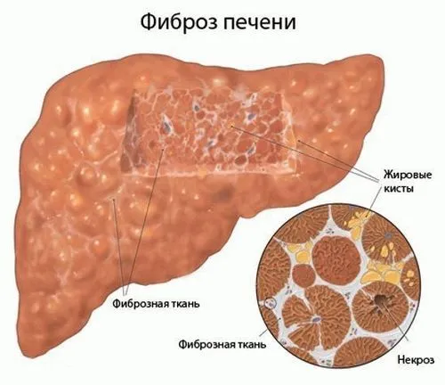 лікувати печінку після алкоголю