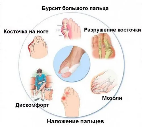 бурсит великого пальця стопи стопи лікування симптоми фото