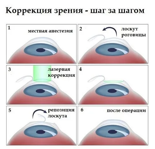 короткозорість