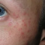 як лікувати дерматит у маленької дитини