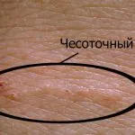 як лікувати коросту на обличчі