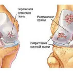 як лікувати ерітродерміческій псоріаз
