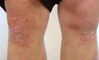 як лікувати вульгарний псоріаз