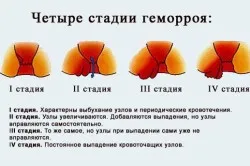 як лікувати геморой і що це таке