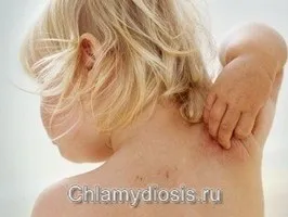 як вилікувати коросту вагітної