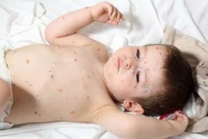 Короста у дітей як лікувати коросту у дітей