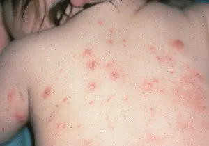 як лікувати коросту