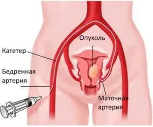 чи можна гормональними таблетками лікувати ендометріоз