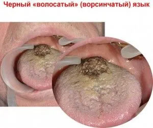 як лікувати чорний язик