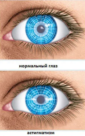 нове в лікуванні астигматизму