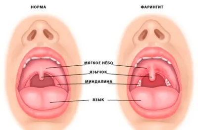 хронічний фарингіт у дітей