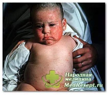 Цитомегаловірус лікування цитомегаловірус лікування