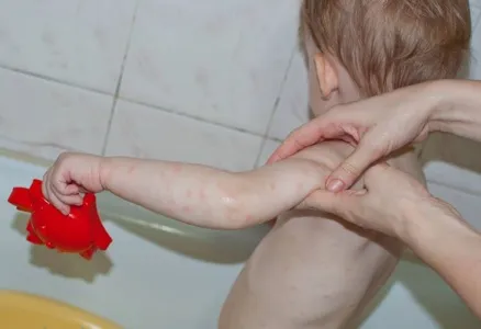 короста діти прояви симптоми