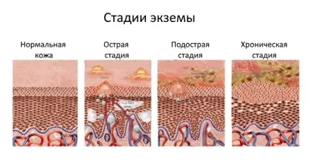 як лікувати екзему дерматит