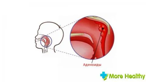 Діагноз - аденоїди 3 ступеня лікування і профілактика