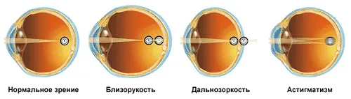 як лікувати змішаний астигматизм
