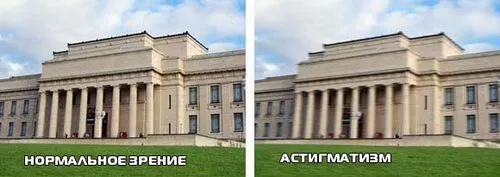 як лікувати змішаний астигматизм