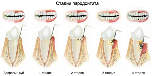 як лікувати ясна якщо вони кровоточать