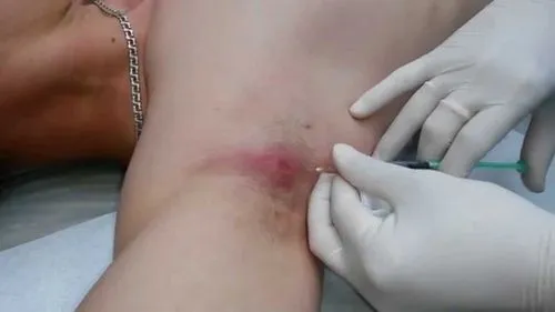 чиряк під пахвою лікувати причина робити лікування набряку пахва як що