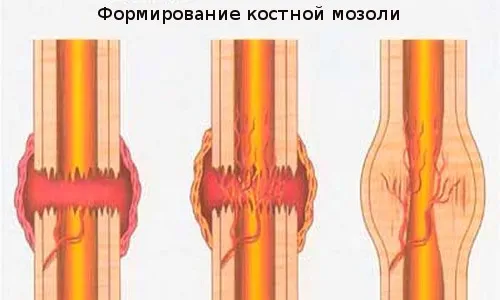 як лікувати кісткову мозоль в домашніх умовах