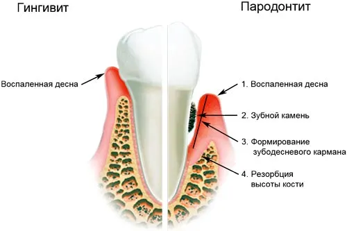 як лікувати ясна якщо вони кровоточать