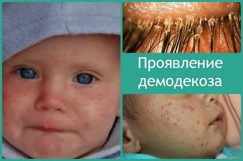 демодекоз