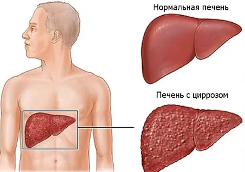 цироз печінки