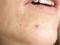 як лікувати фурункули назавжди