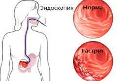 лікування гастриту