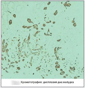 як лікувати дисплазію шлунка