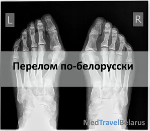 хронічний періодонтит