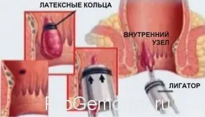 лікувати кров'яної геморой