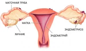 як швидко вилікувати ендометріоз народними засобами