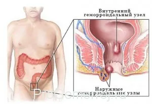 геморой кровит робити зупинити кров лікування