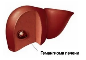 як лікувати гемангиому печінки народними засобами