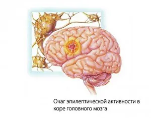 фокальна епілепсія симптоматична криптогенная дітей мультифокальна напад сімтопм причина лікування діагноз